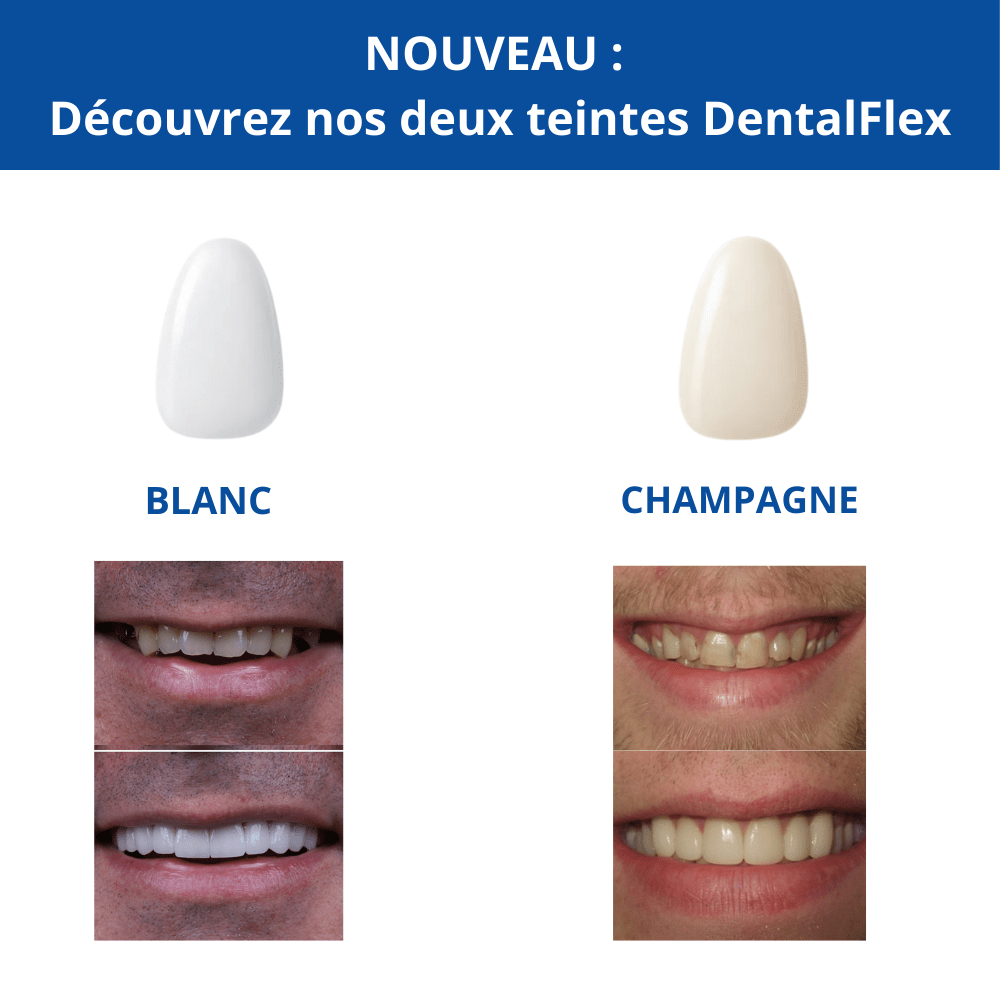 DentalFlex™ | Set de facettes modulables (haut et bas)