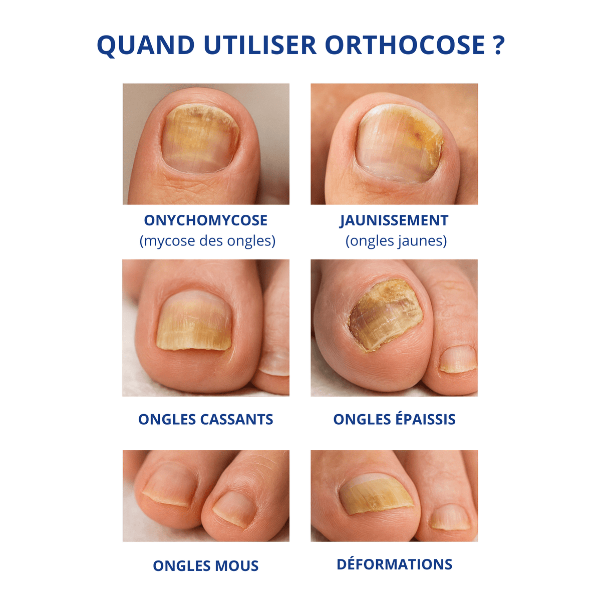 OrthoCose™ | Appareil anti-mycoses